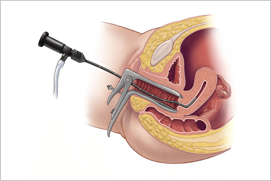 Laparoscopic Surgery